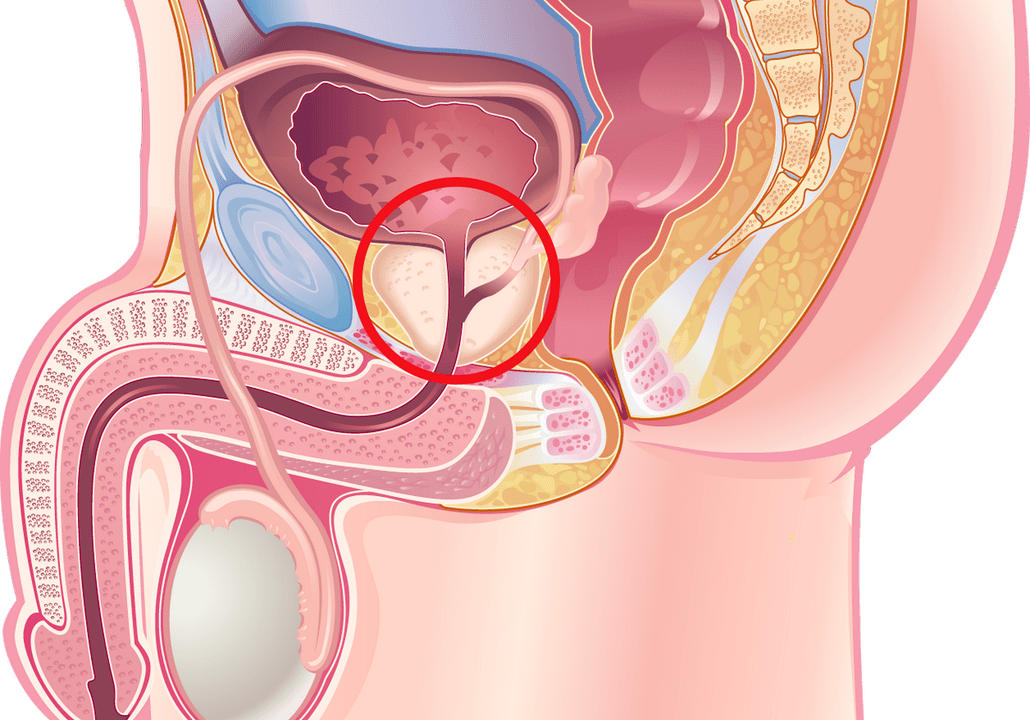 Signs and Symptoms of Prostatitis