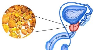 the types of prostatitis