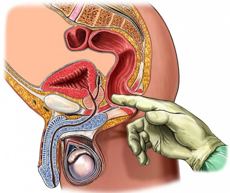 Prostate massage to treat prostatitis