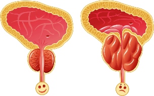 The normal prostate and inflamed