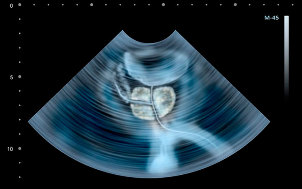 Signs of prostatitis ULTRASOUND