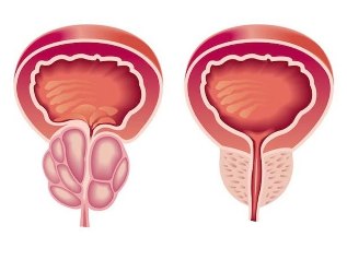 As it seems prostatitis